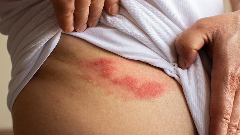 Mann med utslett på grunn av helvetesild.